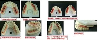 Abutments and Crowns