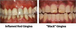 Inflamed Gingiva